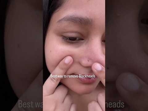 Remove Blackheads ✨